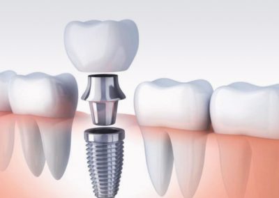 implantes multiples